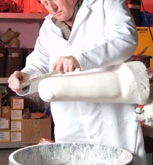 Pedorthist preparing cast of stump for custom-molded prosthetic